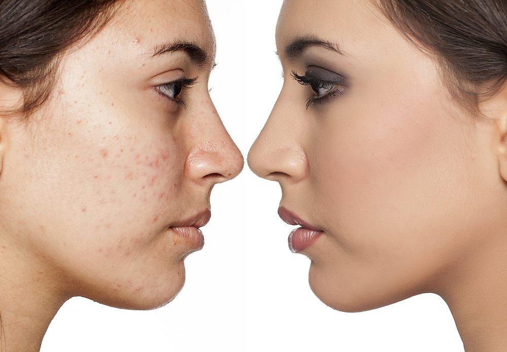 Acne facial