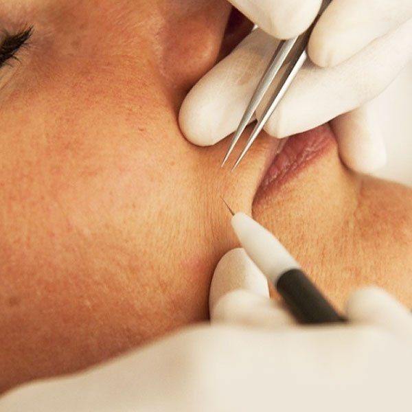 Electrolysis treatment on the face